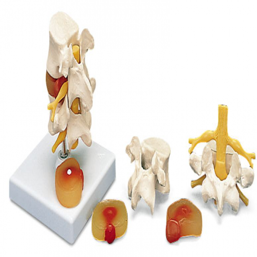 2節(jié)腰椎帶2個病變椎間盤模型
